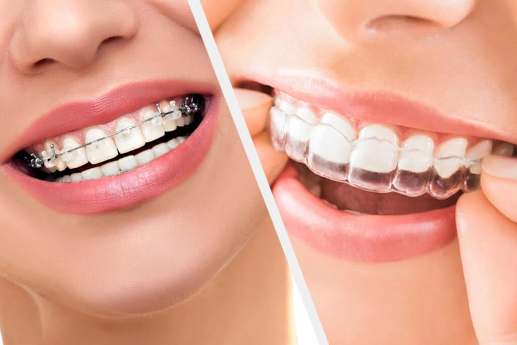 Invisalign Vs braces
