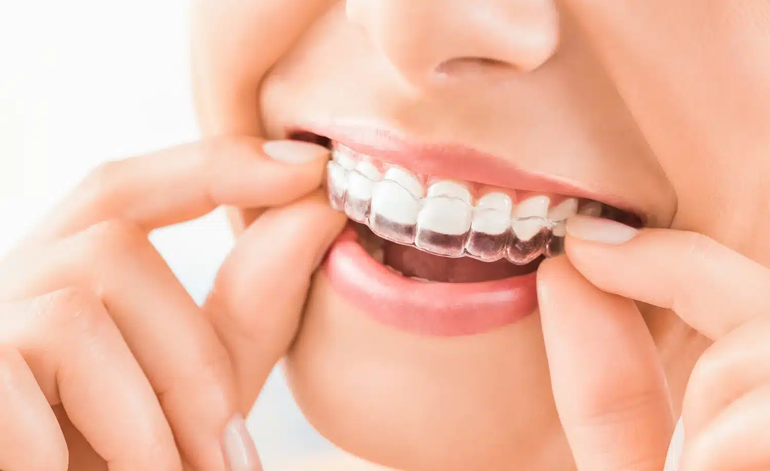 Woman Wearing invisible braces